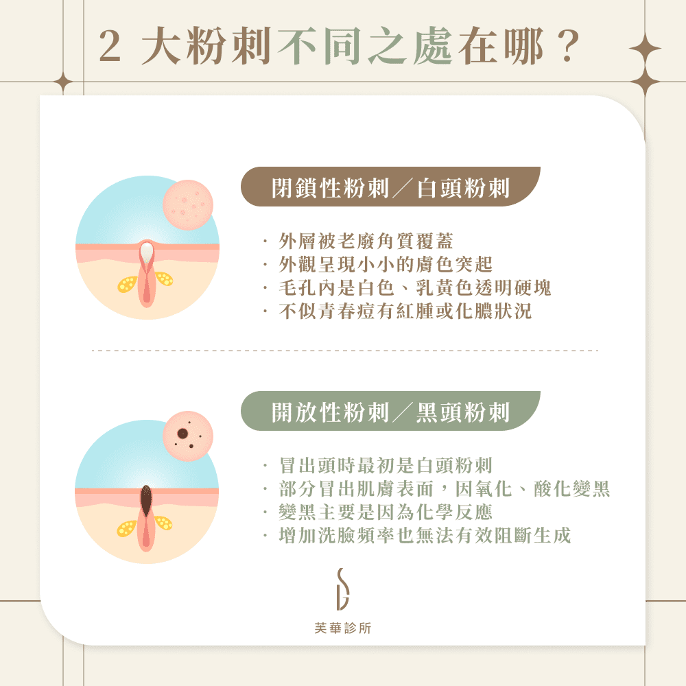 粉刺大軍快退散!採取對的清粉刺技巧,粉刺清除有效又不傷膚