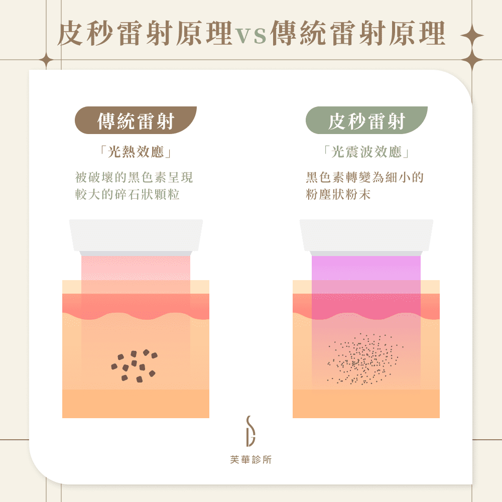 皮秒雷射原理 vs 傳統雷射原理
