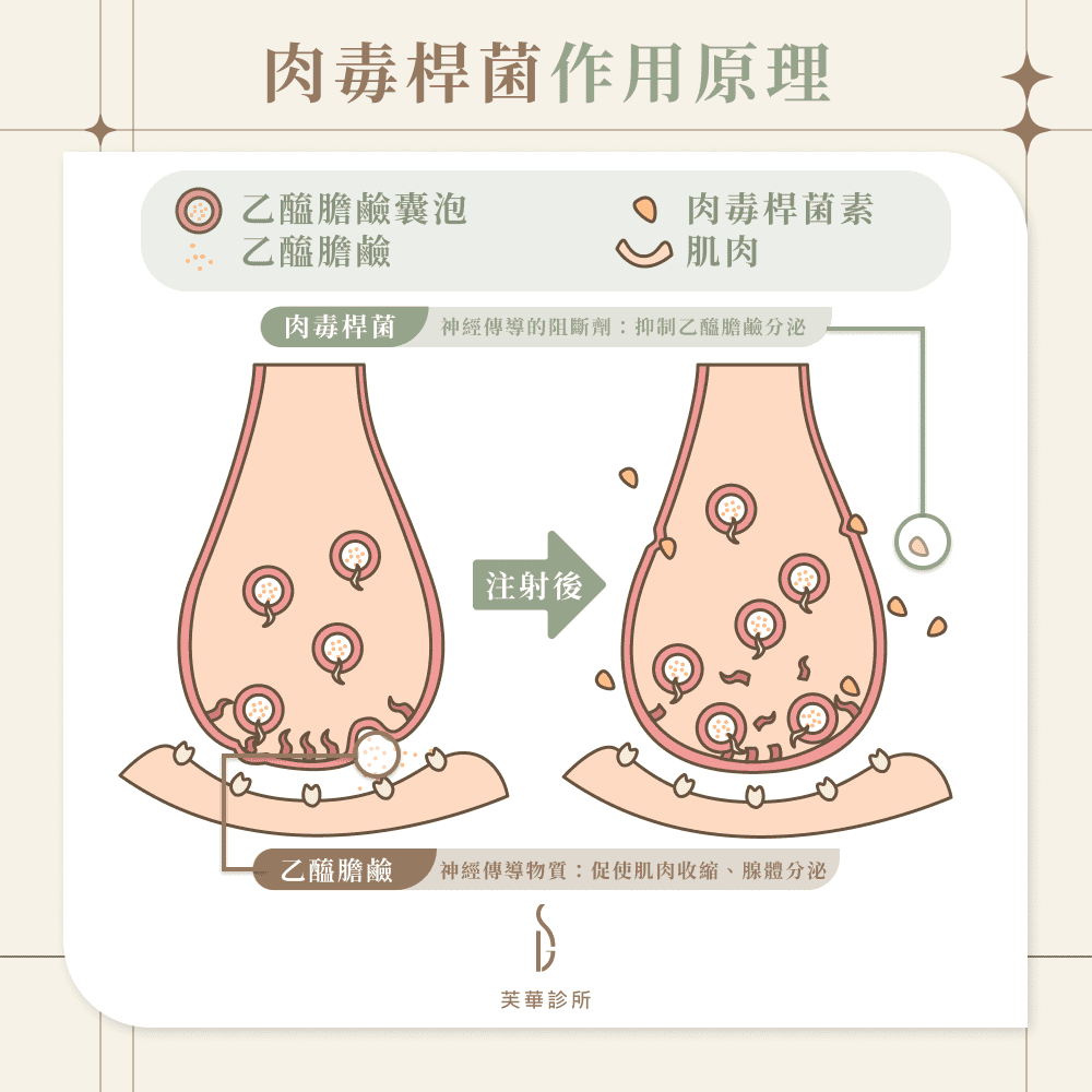肉毒桿菌作用原理